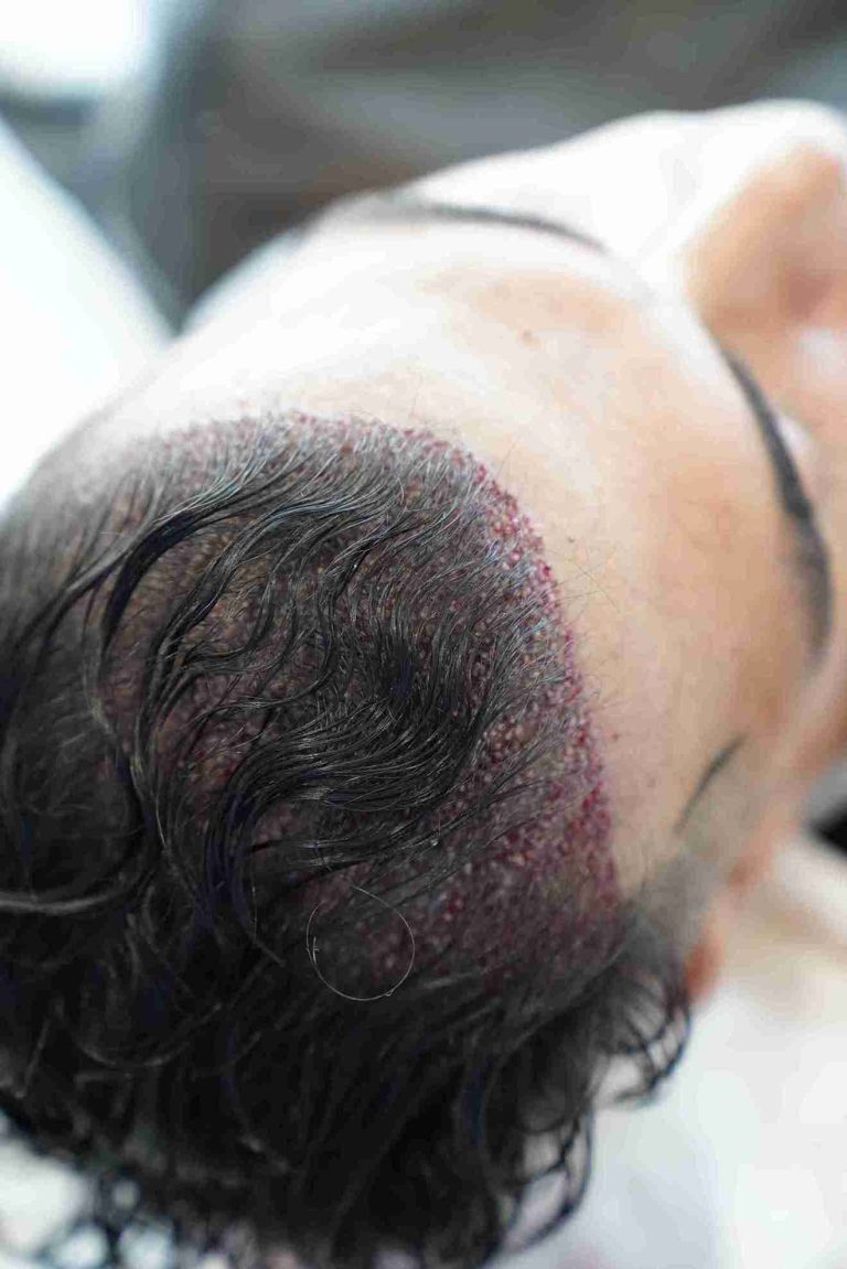 Close-up view of a person’s scalp after a long hair transplant procedure, showing freshly implanted hair follicles with visible redness and tiny scabs