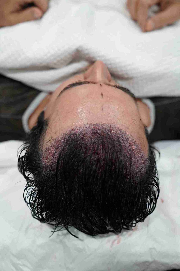 Close-up view of a person’s scalp after a long hair transplant procedure, showing freshly implanted hair follicles with visible redness and tiny scabs