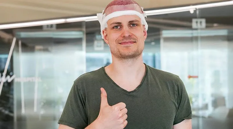 A man with a shaved head and visible redness on his scalp gives a thumbs-up after a hair transplant procedure. He has white bandages around the sides of his head and is wearing a green T-shirt while standing indoors.