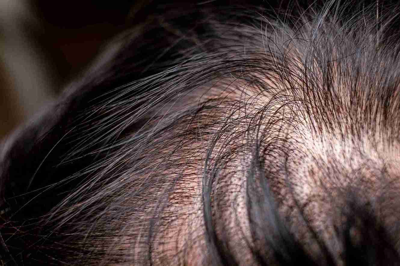 Close-up of thinning hair on the scalp, often used to illustrate hair loss concerns and answer the question: Do Hair Transplants Work?