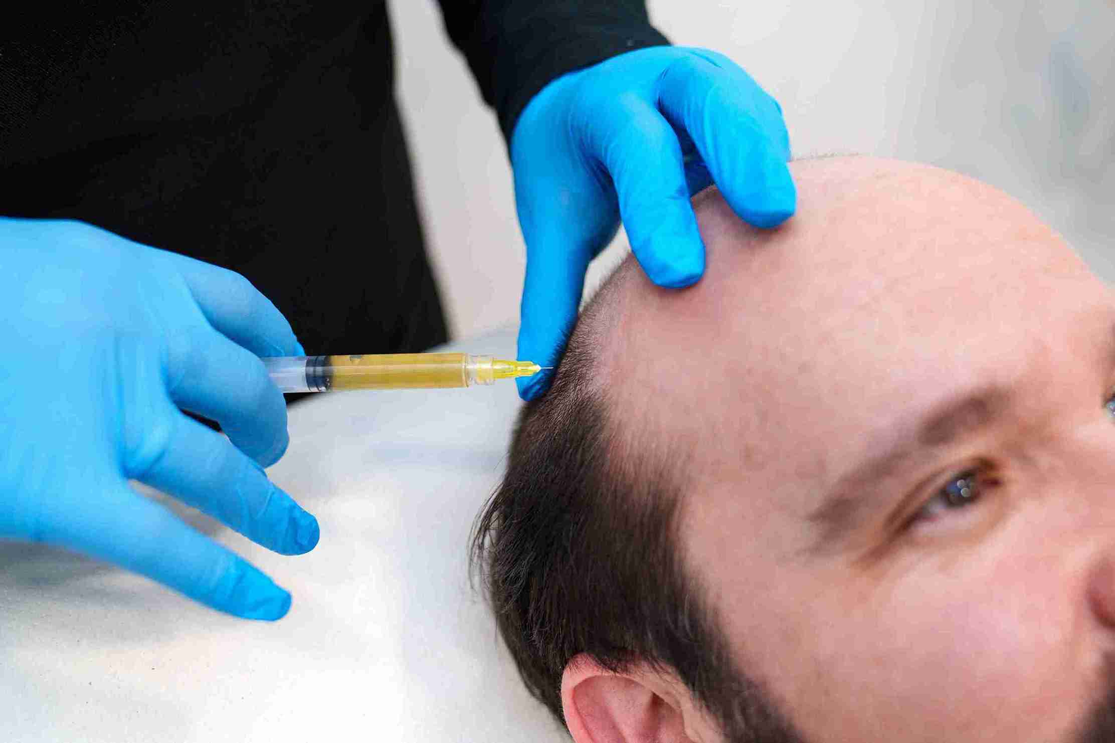 Doctor performing PRP for Hair Loss treatment by injecting platelet-rich plasma into a man's scalp to stimulate natural hair growth.