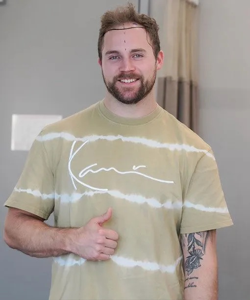 A smiling man with a beard gives a thumbs-up while standing indoors. He has visible marks on his scalp, indicating he recently underwent a hair transplant procedure. He is wearing a light brown tie-dye style T-shirt with white stripes and a tattoo on his left forearm.