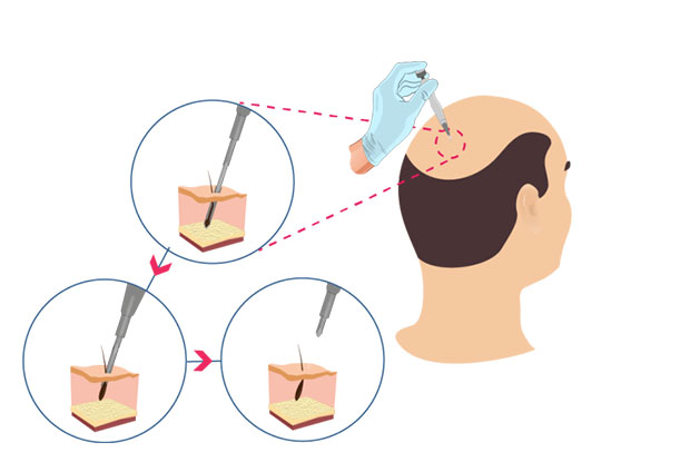 Que es el trasplante de cabello dhi