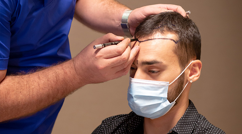 Transplante de pelo