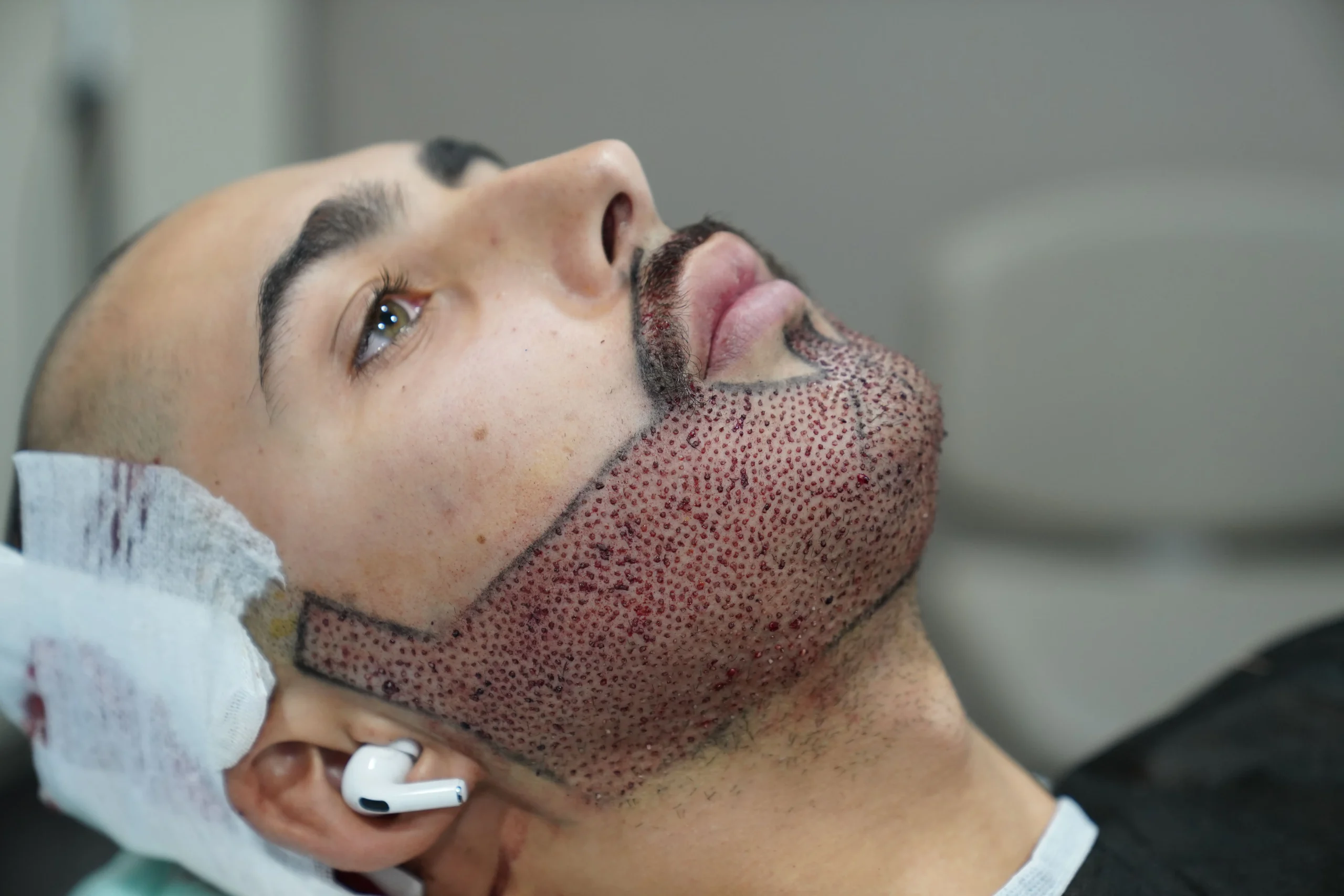 Greffe de Barbe Turquie