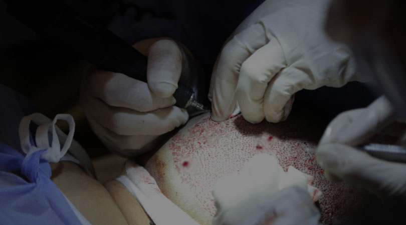 Technique Micro FUE