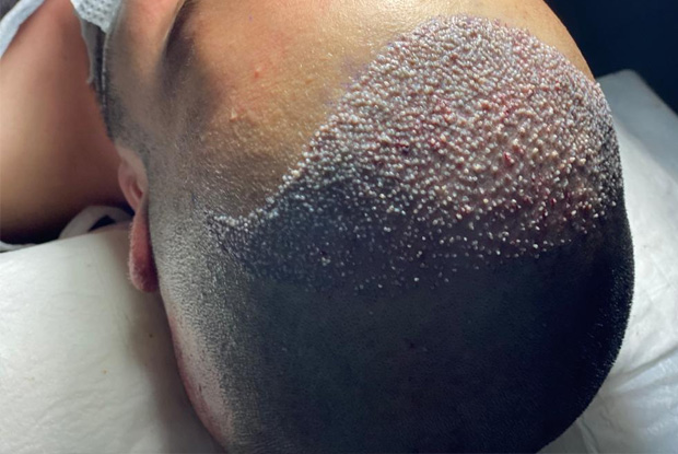 vantaggi del trapianto di capelli Fue con zaffiro