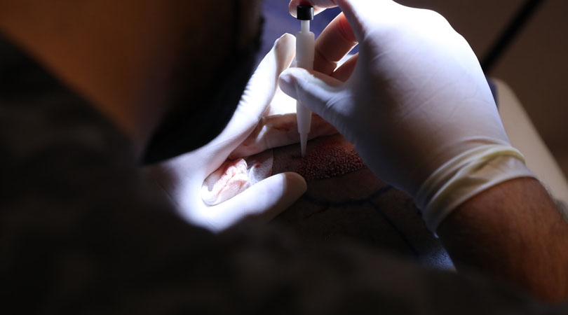 Hair Transplant for Hiv Positive Patients