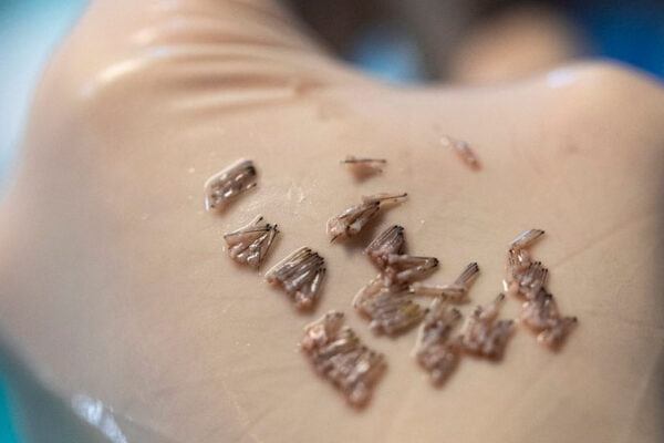 Saç Ekiminde En iyi Yöntem Hangisidir?