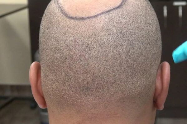 Saç Ekiminde Enseden Alınan Saç Tekrar Çıkıyor mu?