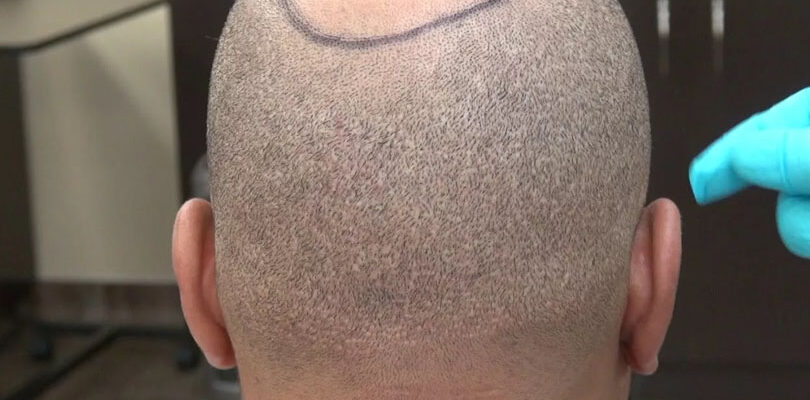 Saç Ekiminde Enseden Alınan Saç Tekrar Çıkıyor mu?