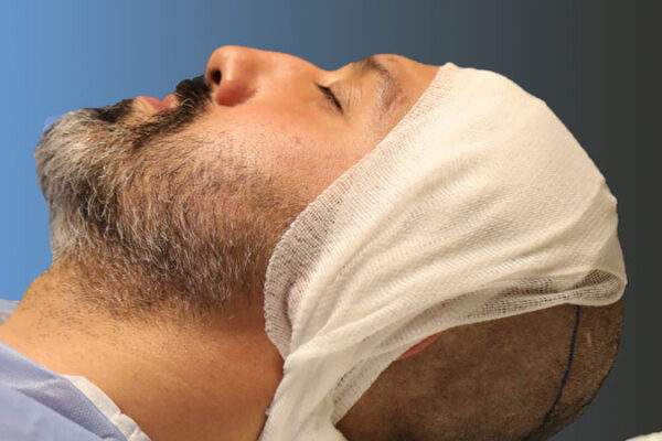 Saç Ekimi Sonrası Kabuklar Nasıl Temizlenir?