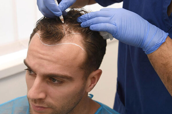 Saç Ekiminde Kabuklar Nasıl Dökülür?