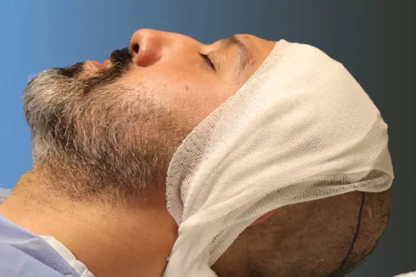 Comment Les Croûtes Tombent-Elles Après Une Greffe De Cheveux?