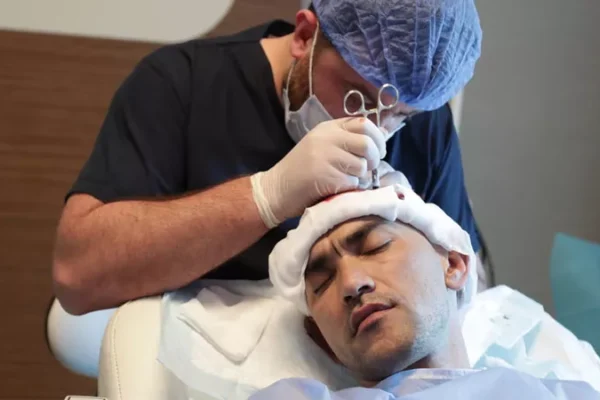 Quando ricrescono i capelli trapiantati?