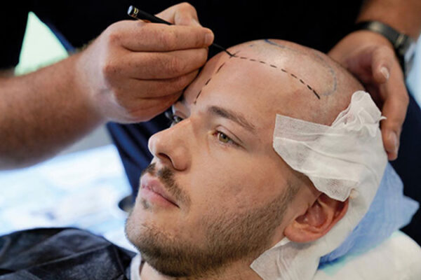 Saç Ekimi Sonrası Kanama