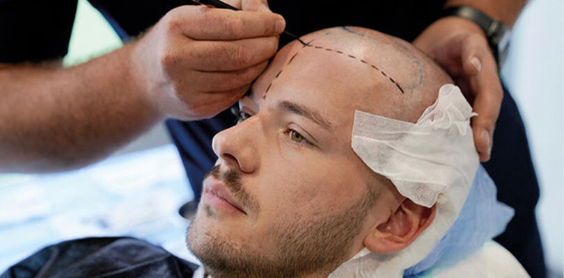 Saç Ekimi Sonrası Kanama