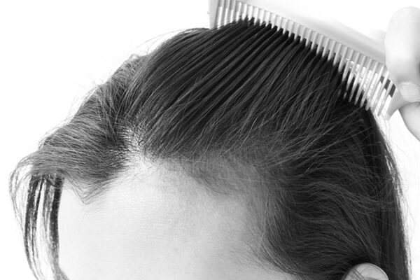 Hamilelikte Saç Dökülmesi Problemi