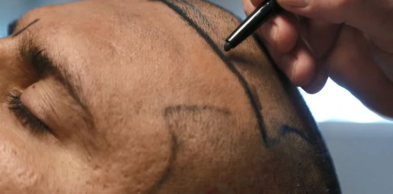 herkes saç ekiminde uygun bir aday mıdır