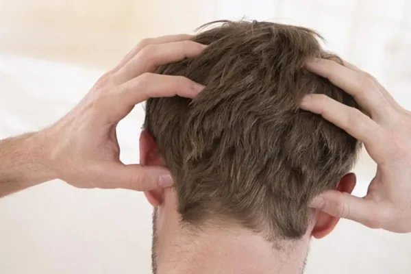 Come Scompare Il Prurito Dopo Il Trapianto Di Capelli?