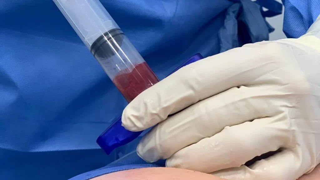 Trattamento dei Capelli con Cellule Staminali