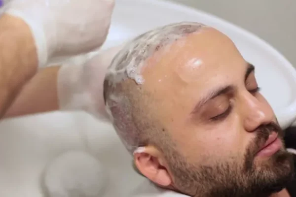 Comment Se Laver Après Une Greffe De Cheveux?