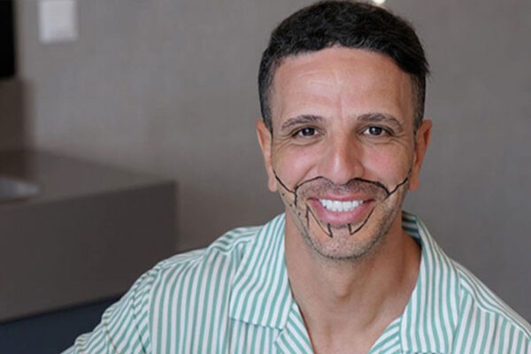 Otolog Mikro Greft Hakkında Merak Edilenler