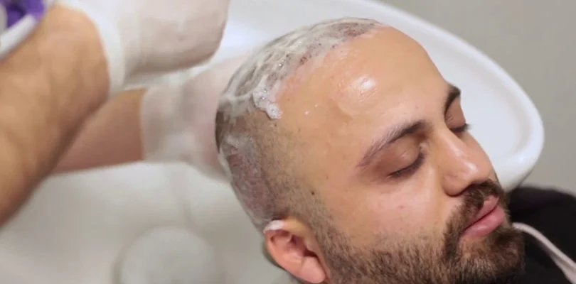 post operatif saç yıkama