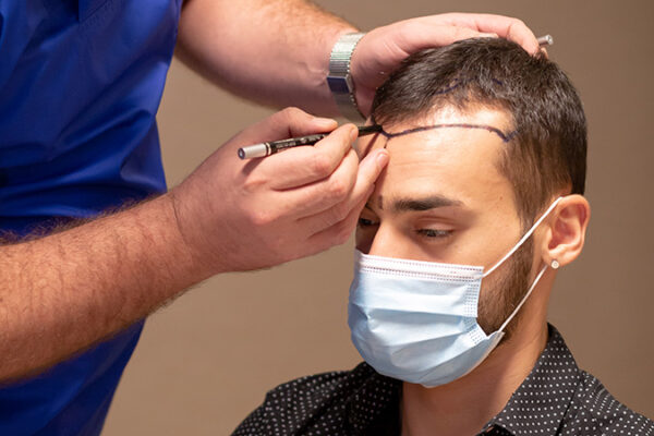 Saç Ekimi İzi Ne Zaman Geçer?