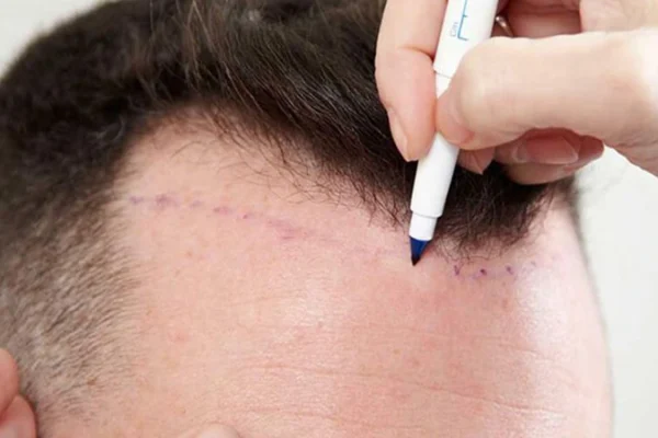 Saç Ekimi Hastaları Gelmeden Önce Neler Yapmalıdır?