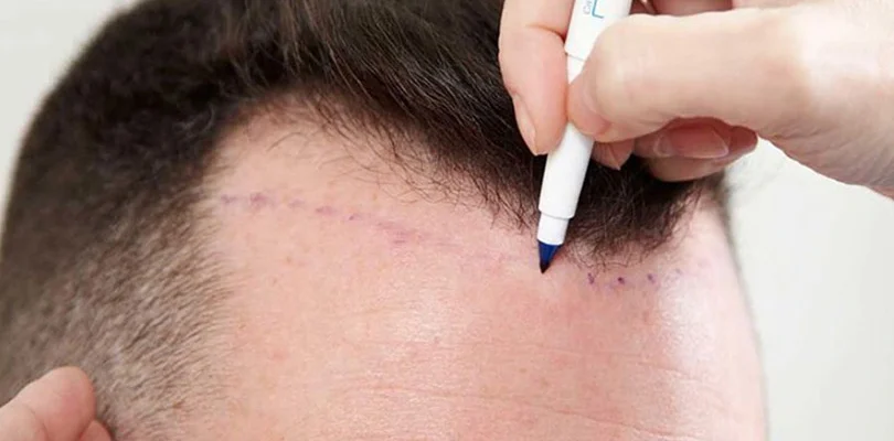 saç ekimi hastaları gelmeden önce neler yapmalıdır