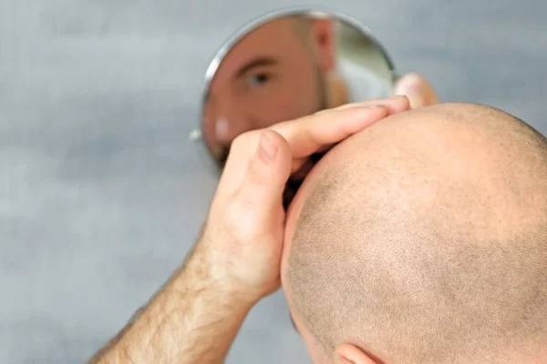 Come si svolge il periodo di recupero dopo un trapianto di capelli?