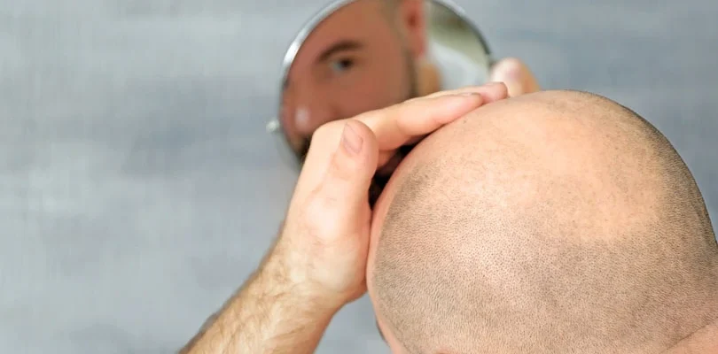 saç ekimi sonrası iyileşme süresi nasıldır