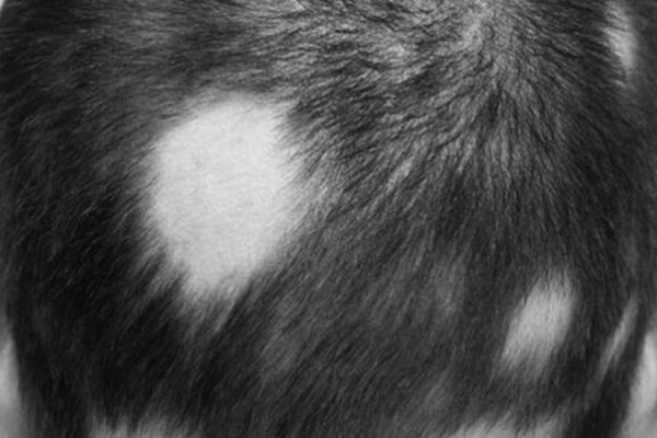 Saç Kıran Nedir, Nasıl Tedavi Edilir?