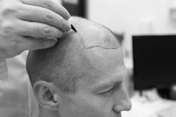 Şeker Hastalarında Saç Ekimi Süreci