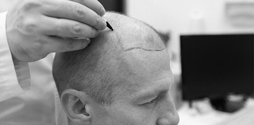 şeker hastalarında saç ekimi