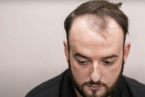 Seyrek Saçlar Ekilir mi?