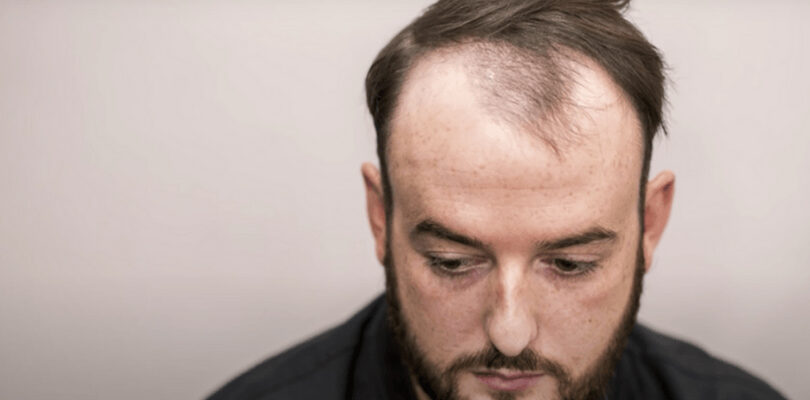 seyrek saç ekilir mi