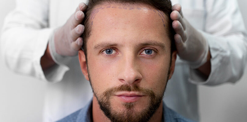 son teknoloji saç ekimi