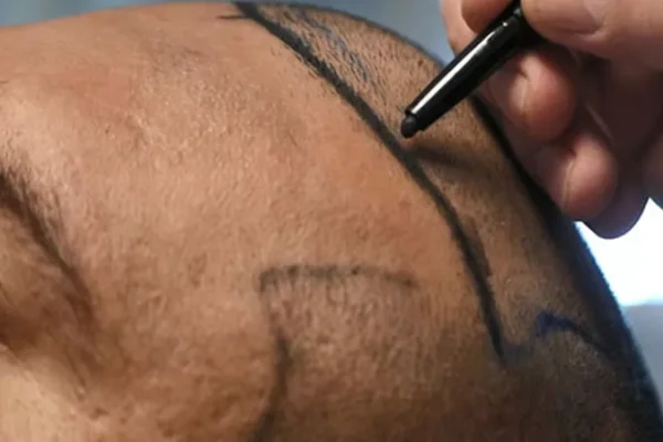 Comment Est Le Temps De Récupération Après La Greffe De Cheveux?