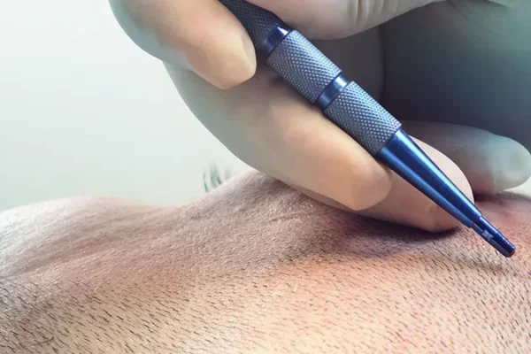 Trapianto Di Capelli FUE Con Zaffiro