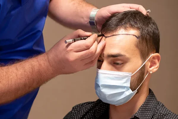 Prima Del Trapianto Di Capelli