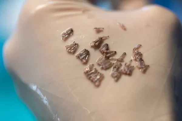 Trapianto Di Capelli FUE