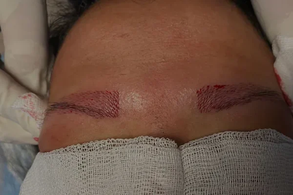 Trapianto Di Sopracciglia