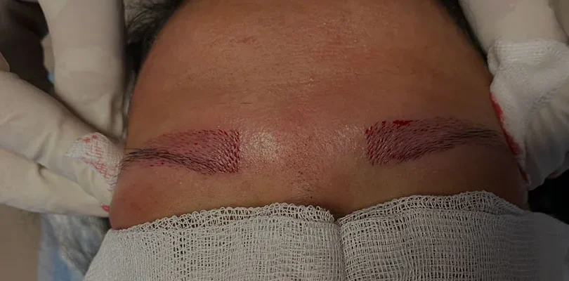 Trapianto di sopracciglia