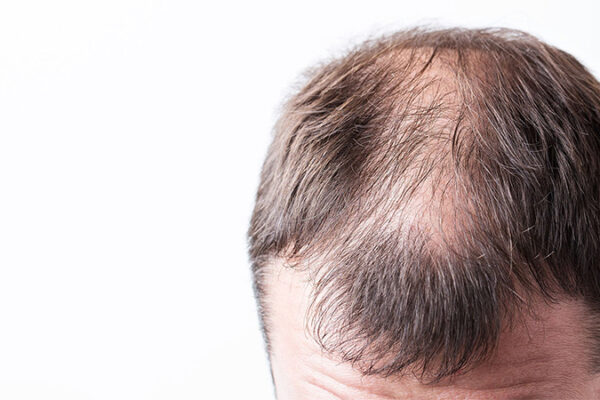 Yaz Aylarında Saç Ekimi Yapılabilir mi?