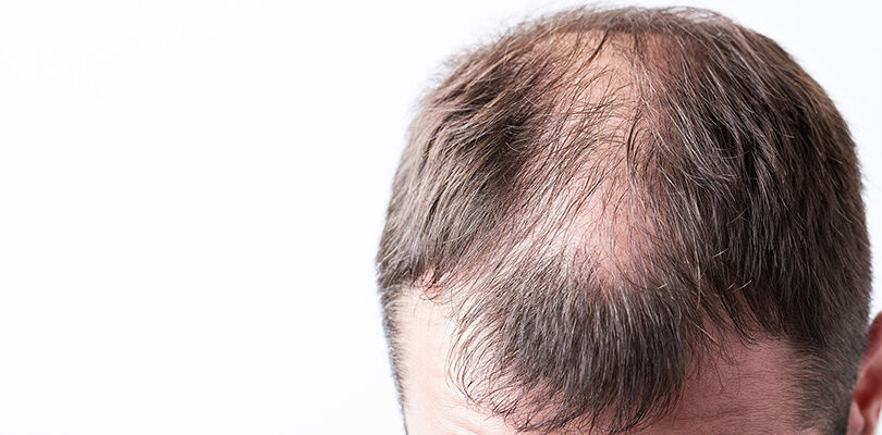 yaz aylarında saç ekimi