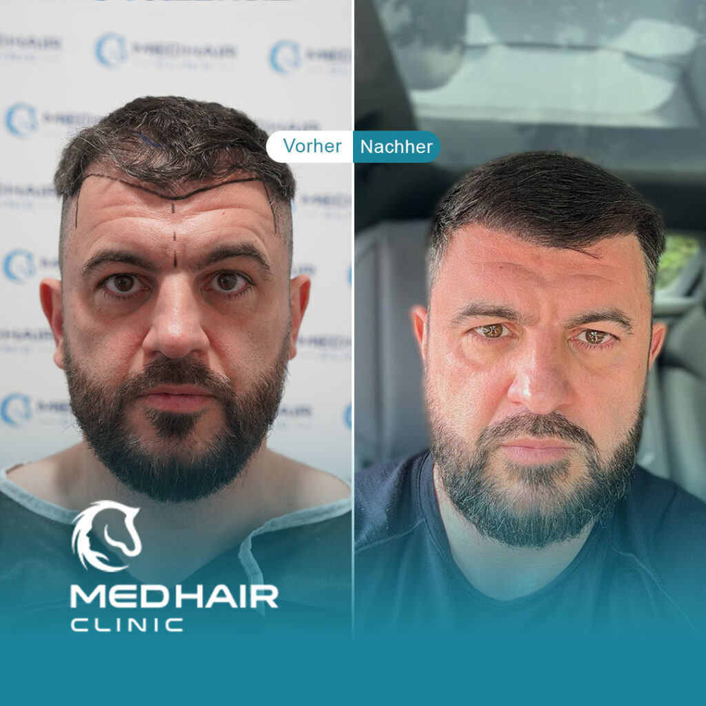 Haartransplantation vorher nachher 2500 Grafts aus der Türkei