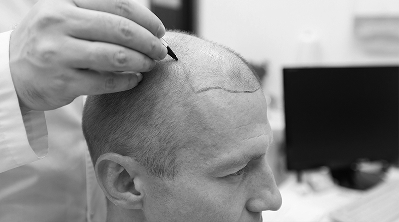 Hair transplantation process in diabetes patients – safe procedure and medical considerations