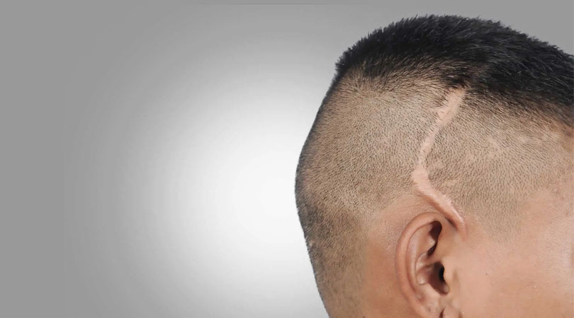 Scars hair transplantation – hair restoration procedure to cover scarred areas on the scalp